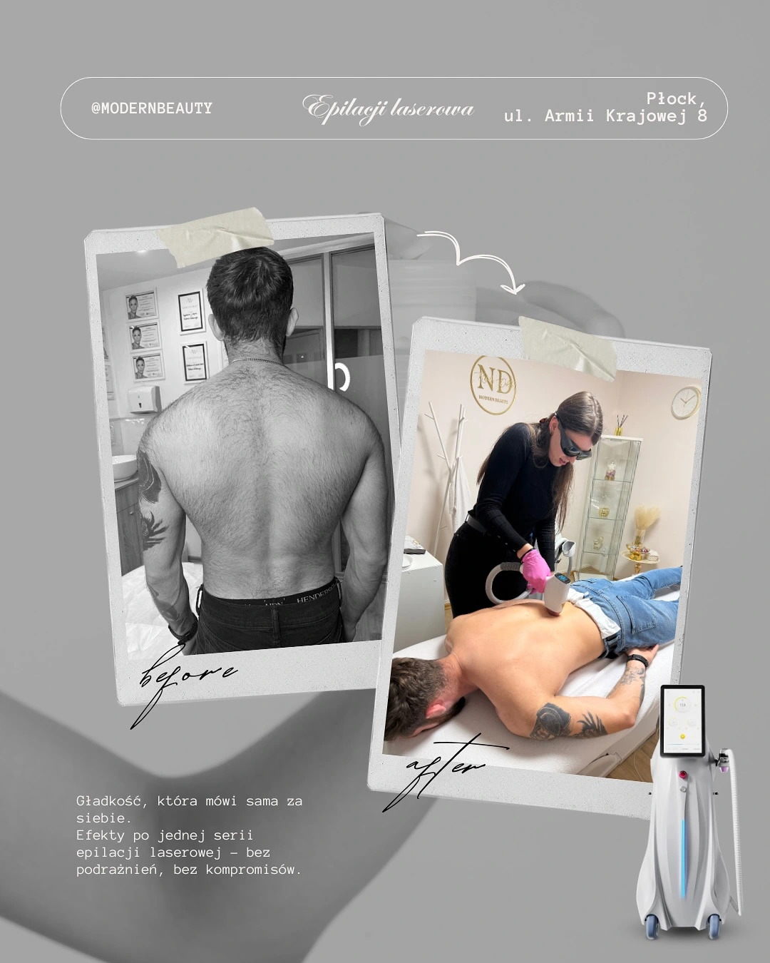 Epilacja laserowa Płock - usuwanie bezbolesne włosów laserem